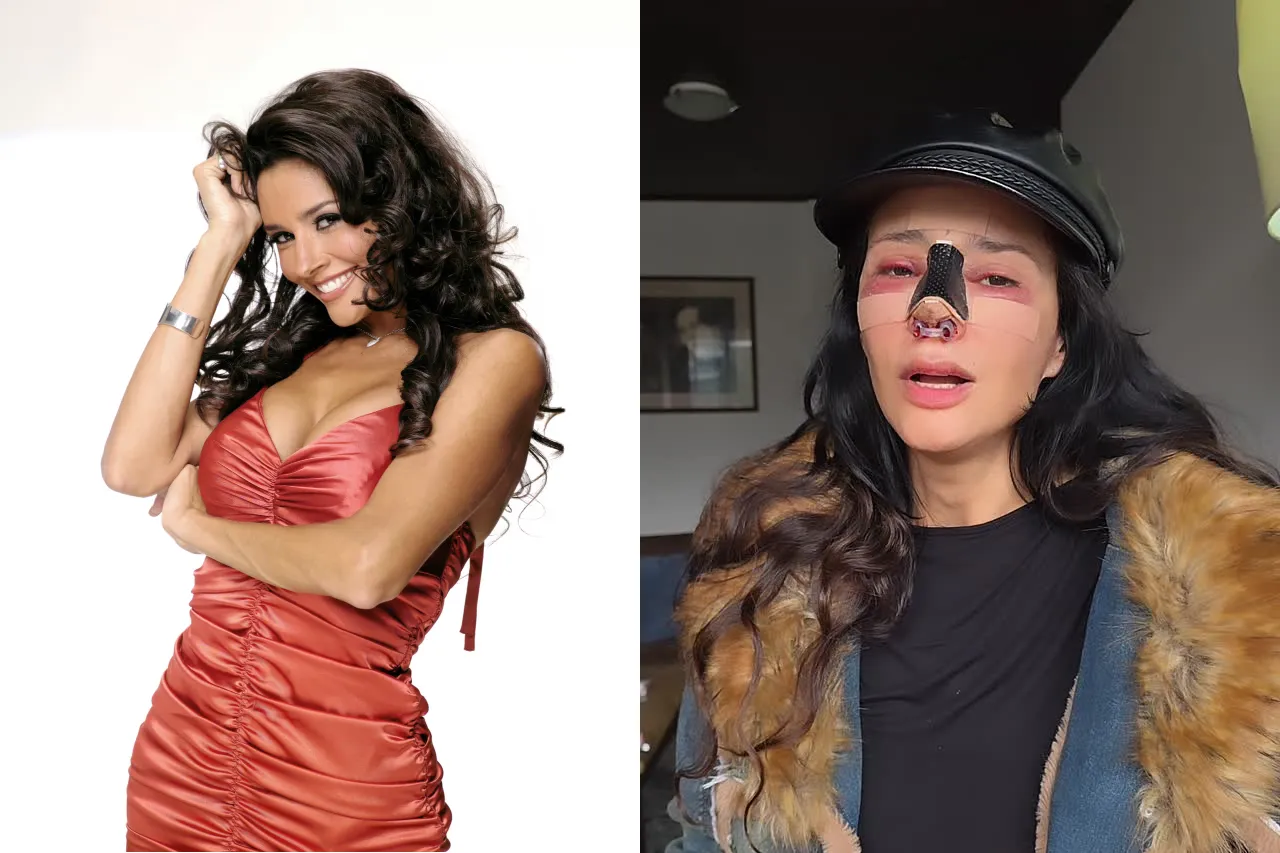 La Cirugía Estética en la Lupa: Dorismar Confirma Mala Práctica en Colombia y Busca Un Nuevo Rostro